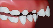 Teeth Protrusion
